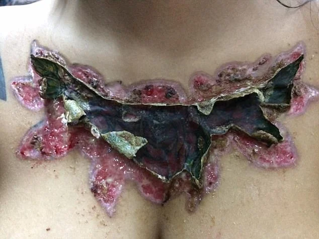 Garota relata momentos de dor ao remover tatuagem com método polêmico - imagem 6 Garota relata momentos de dor ao remover tatuagem com método polêmico - imagem 6