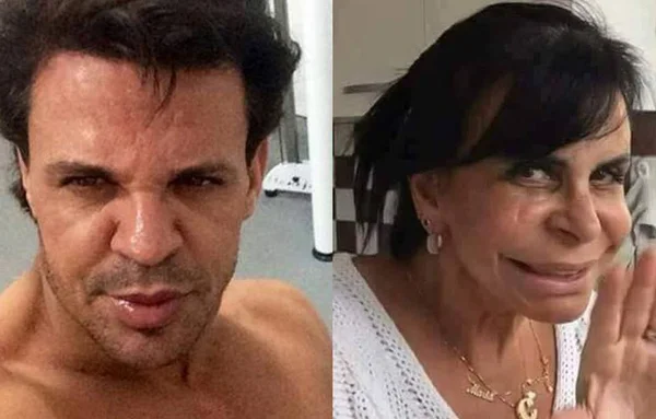Após procedimento estético, Eduardo Costa é comparado a Gretchen