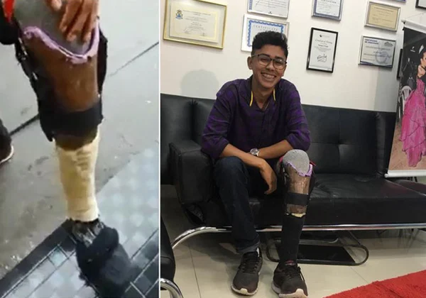 Empresário doa prótese a rapaz que viralizou com “perna caseira”