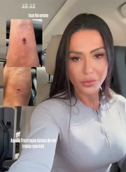 Gracyanne Barbosa mostra machucado que sofreu em acidente na academia