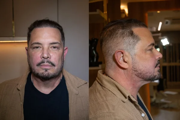 Conrado faz harmonização facial e muda o visual; veja o antes e depois - destaque galeria