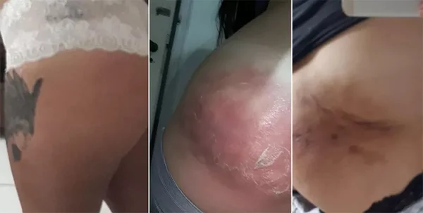 Mulher tem infecção após injeção