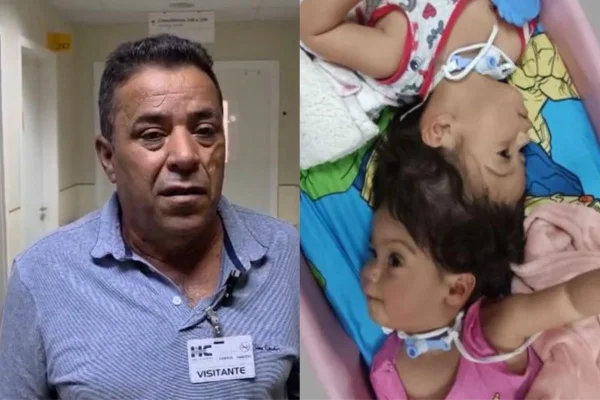 pai de siamesas que morreram em separação