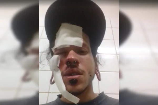 Grafiteiro espancado por skinheads no DF tem melhora e deixa UTI