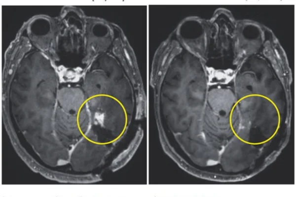 Duas imagens de cérebro humano com e sem tumor - Metrópoles