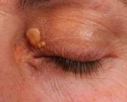 São eles: xantelasmas e xantomas (pequenas bolinhas de gordura que aparecem na pele), dores na barriga, nos dedos dos pés e das mãos