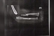 Bebê é levada ao hospital com ossos quebrados e pais são presos - imagem 2 Bebê é levada ao hospital com ossos quebrados e pais são presos - imagem 2