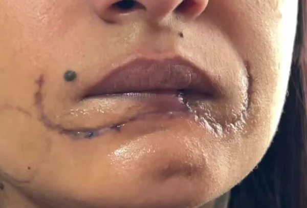 Mulher perde metade do lábio