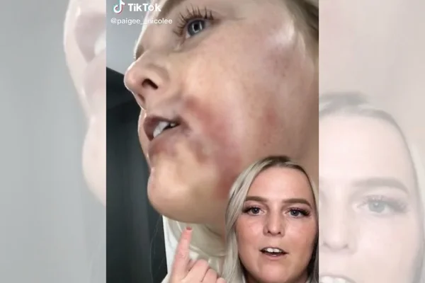 Jovem relata problemas após preenchimento labial: “Traumatizada”