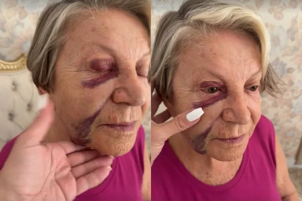 Imagem colorida mostra os hematomas no rosto da mãe de Poliana Rocha - Metrópoles