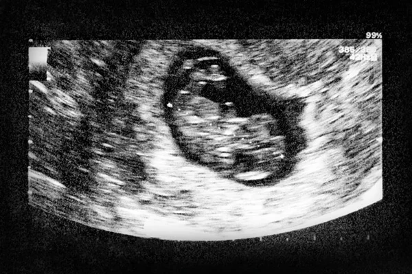 Ultrassom de bebê