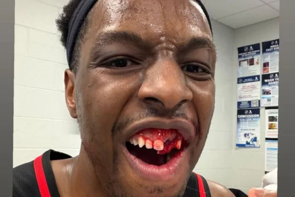NBA: cotovelada de astro dos Celtics faz Okongwu perder dente