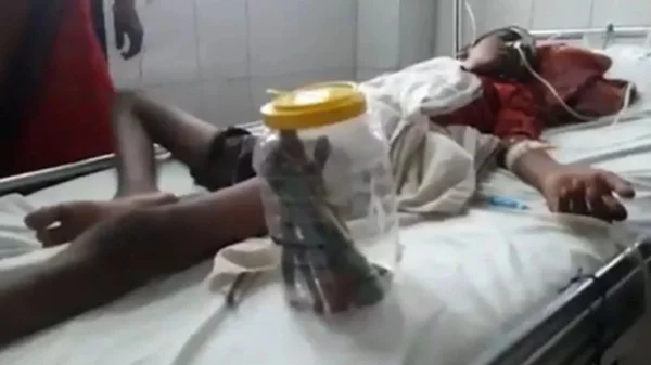 Jovem passa por cirurgia de emergência ao engolir 16 escovas de dente e 1 prego
