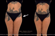 Antes e depois do bumbum da miss São Paulo, Valentina Miranda