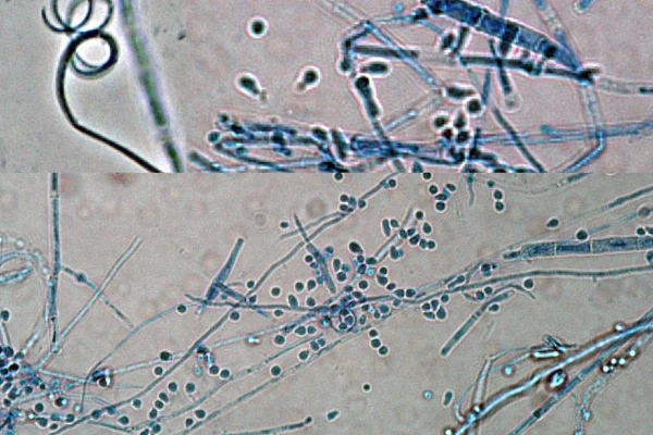 Microconídios, macroconídios e hifas espirais de Trichophyton indotinea