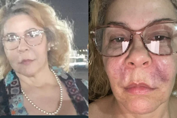 Katia Diniz aplicou PMMA no bigode chinês, mas enfrentou inflamações que chegaram até o pulmão