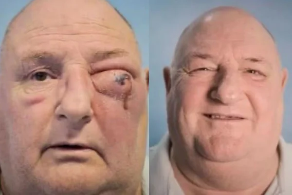 Homem branco careca. Foto a esquerda mostra o homem com uma infecção no olho esquerdo e na foto da direita ele aparece recuperado