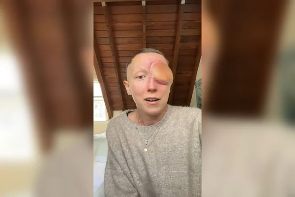 Foto colorida de Annika - mulher americana que teve Carcinoma nasossinusal