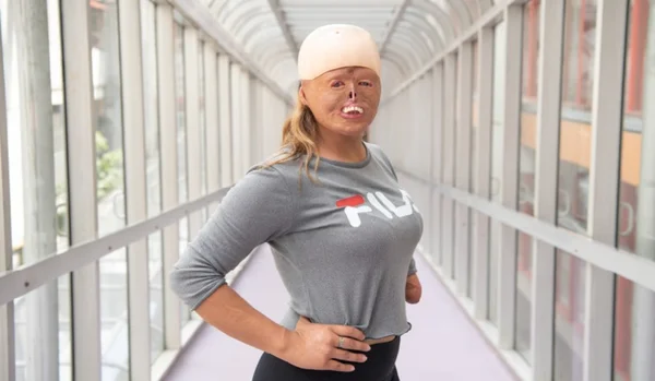 Brisa, modelo e atleta que teve 88% do corpo queimado
