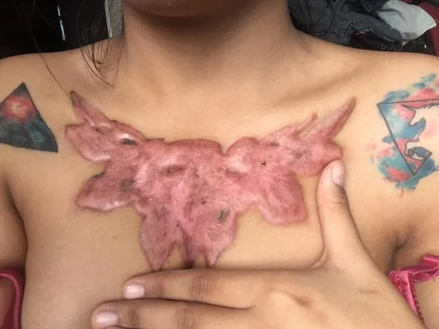 Garota relata momentos de dor ao remover tatuagem com método polêmico - imagem 13 Garota relata momentos de dor ao remover tatuagem com método polêmico - imagem 13