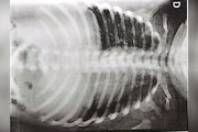 Bebê é levada ao hospital com ossos quebrados e pais são presos - imagem 4 Bebê é levada ao hospital com ossos quebrados e pais são presos - imagem 4
