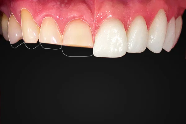 Facetas dentárias: veja riscos da técnica que causou morte em GO