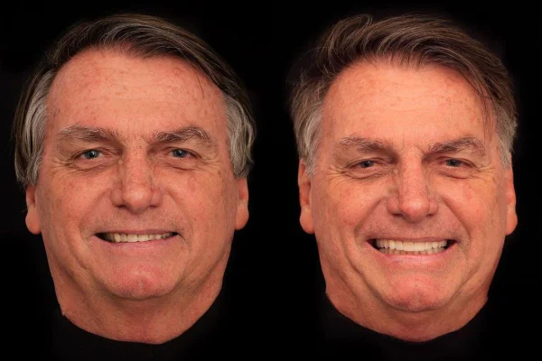 Harmonização de bolsonaro