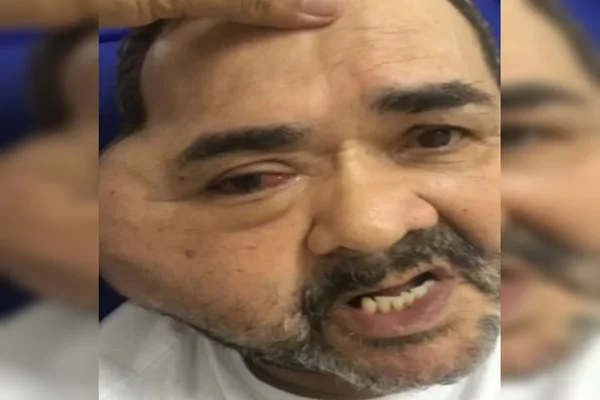 Imagem colorida do idoso José Nilton Cardozo, que vive com tumor gigante - Metrópoles
