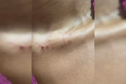 Hematomas no pescoço