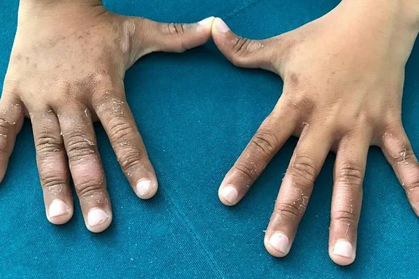 Criança fica com manchas e bolhas ao entrar em mar contaminado