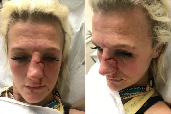 Imagens: ex-lutadora do UFC tem nariz quebrado por ex-namorado