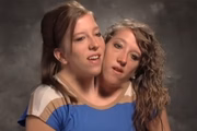 As gêmeas Abby e Brittany têm uma condição rara conhecida como parapago dicefálico, na qual duas cabeças ficam lado a lado em um único torso