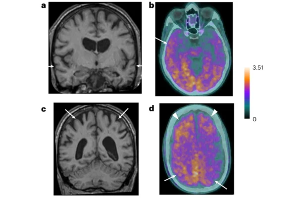Imagens de tomografia de cérebro humano com Alzheimer - Metrópoles