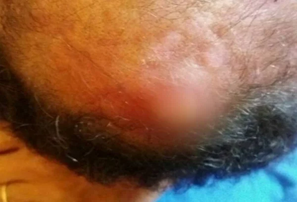 Morre homem que teve gaze esquecida dentro da cabeça