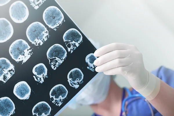 Trombose pode desencadear doenças como AVC e embolia pulmonar