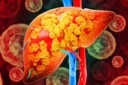 A esteatose hepática é popularmente conhecida como gordura no fígado