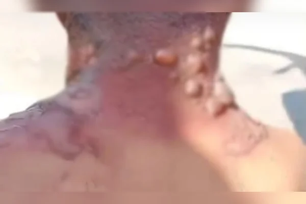 Homem é queimado por namorada com água quente