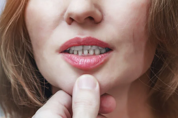 Imagem em close da boca de uma mulher - câncer de boca - bactérias da boca - risco de alzheimer
