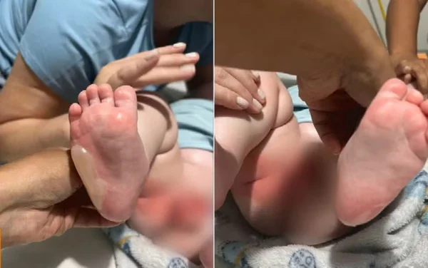 imagem colorida bebe queimaduras berçario goias