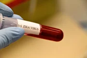 Os sintomas da zika são iguais aos da dengue, só que a infecção não costuma ser tão severa e passa mais rápido. Há, no entanto, um complicador caso a pessoa infectada esteja grávida