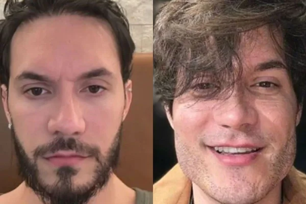 Harmonização facial: como evitar erros ao fazer o procedimento