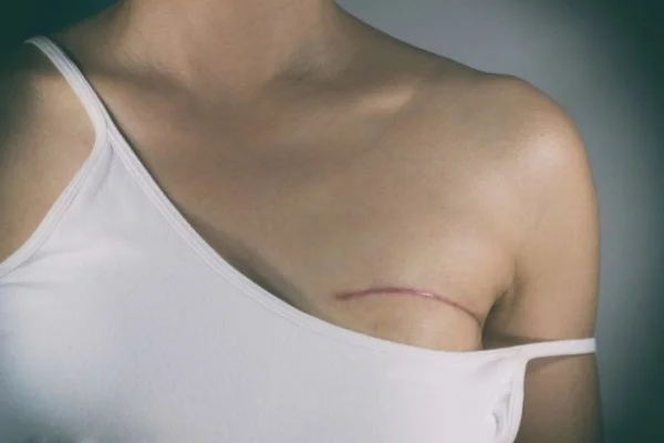 Imagem colorida de busto feminino com blusa branca parcialmente abaixada e cicatriz aparente na pele