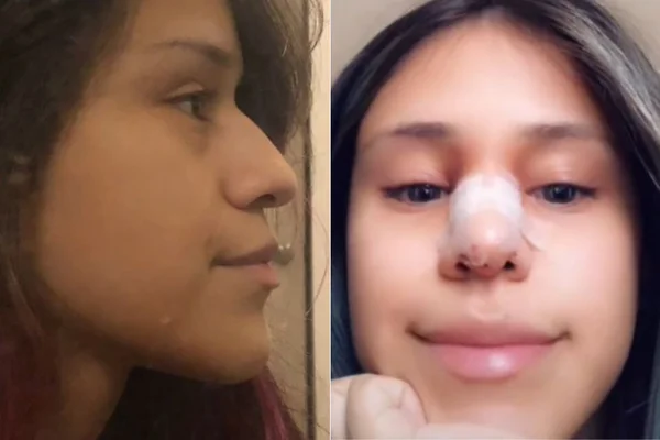 Revanche! Após ser traída, mulher faz ex pagar sua cirurgia plástica