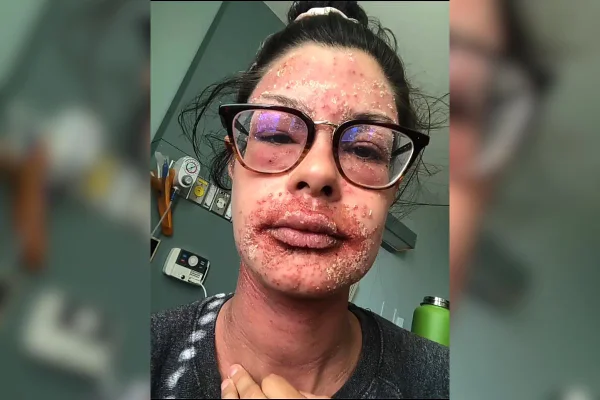 Imagem colorida de mulher de óculos com problema de pele - Metrópoles