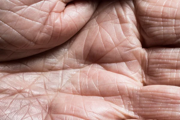 Imagem mostra palma da mão de pessoa idosa, com várias marcas - Metrópoles