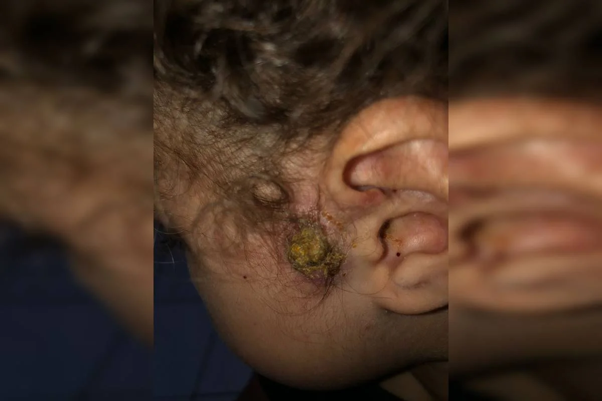 Mãe luta contra o tempo para conseguir operar filha com infecção grave - imagem 4 Mãe luta contra o tempo para conseguir operar filha com infecção grave - imagem 4