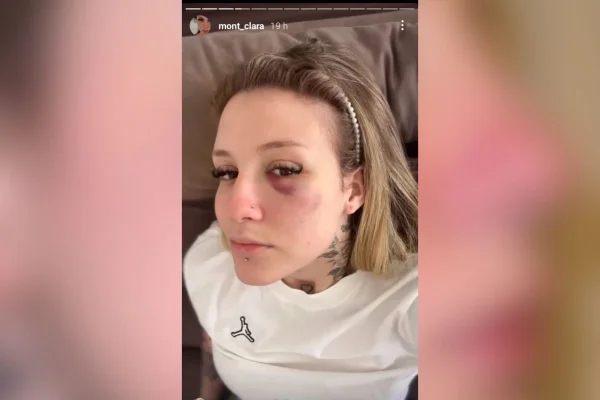 Imagem colorida mostra a influenciadora Clara Monteiro com hematomas no rosto; ela acusa o jogador Caio Paulista, do Palmeiras, seu ex, de agressão - Metrópoles