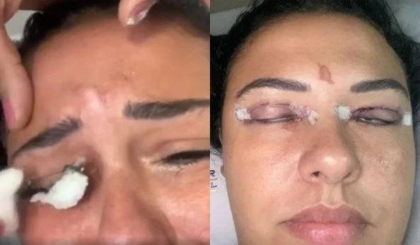 Mulher quase fica cega com extensão de cílios, expert explica os risco