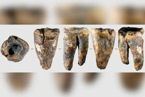 Imagem colorida mostra dente de neandertal com oríficio profundo - Metrópoles