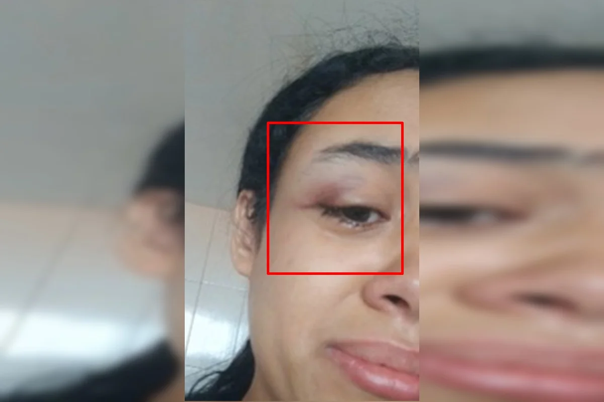 Yasmin já havia apresentado hematoma no olho Yasmin já havia apresentado hematoma no olho